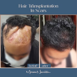 no matter how deep and hard your scar is, we can help!
depending on the placement of the scar, its s
