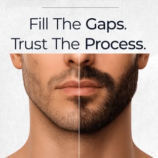 A fuller beard takes more than a procedure it takes time.
As healing progresses and new hairs grow, 