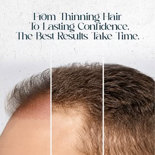 Hair restoration is a journey, not an overnight transformation.
Every stage of healing and growth br