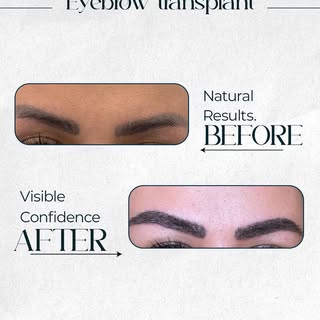 Every successful eyebrow hair transplant begins with precise planning—not just implantation.
This be