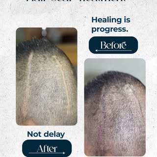 Every transformation starts with patience.
Swelling fades, scars soften, hair grows, and results con