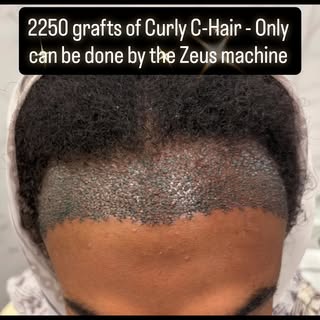Curly hair transplantation isn’t just another procedure—it’s one of the greatest challenges in hair 