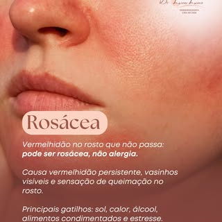 Rosácea: vermelhidão que vai além do rubor passageiro.
Se seu rosto fica vermelho com facilidade, es