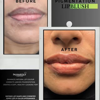Lip micropigmentation (also called lip blush) is a semi-permanent cosmetic procedure that enhances t