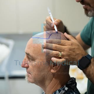 Décision de la ligne frontale ✍🏻| Greffe de cheveux Turquie | Turkisme Medical 

#greffedecheveux #