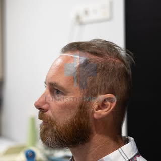 Decision about the frontal line ✍🏻| Hair transplant Turkey | Turkisme Medical

#greffedecheveux #gr