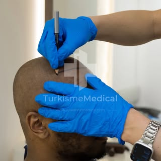 ✨Nouveau | Greffe de cheveux à Paris : intervention encadrée + suivi (J+1)

Greffe de cheveux réalis