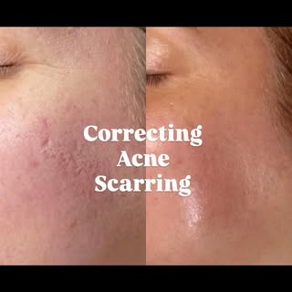 ✨Microneedling RF stimulates collagen production deep within the skin, helping to rebuild, smooth & 
