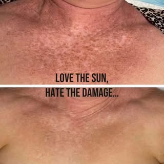🌞 UV exposure leaves behind a lot more than memories.  It breaks down collagen and creates stubborn