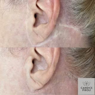 Correcting Face Lift Scars. 🤩

📱 For scheduling, please click the link in our bio. 

.

.
.
.

.
.