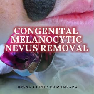 Join Dr. Zulaikha for a Congenital Melanocytic Nevus (CMN) removal procedure ✨

CMN is a mole presen