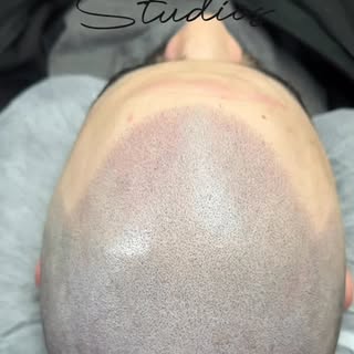 This is a gradual build for this clients hairline with #scalpmicropigmentation at Fresher Studios lo