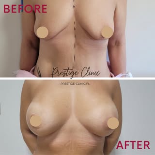 ✨ Powiększanie piersi implantami okrągłymi ✨

Naturalny, pełny efekt i proporcjonalny kształt — to c