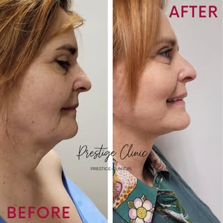 ✨ Efekt Face Lift z liposukcją podbródka – metamorfoza, która odmładza i przywraca kontur twarzy. ✨
