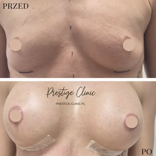 Efekt, który mówi sam za siebie ✨

Implanty okrągłe = pełniejszy dekolt i piękny kształt 💫
Naturaln