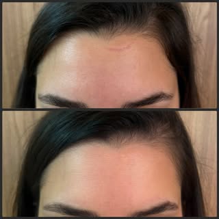 Tratamento de cicatriz em face, com associação de tratamentos: laser + injetável!