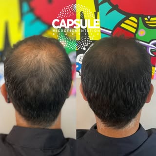 ⚡️NEW STYLE FOR A NEW STYLE⚡️ ✨ Retrouvez l’illusion d’une chevelure plus dense !

La tricopigmentat
