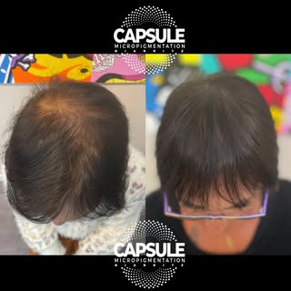 ✨ NEW STYLE GOR A NEW LIFE ! ✨

Cette cliente présentait une perte de densité importante sur le dess
