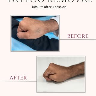 Tattoo removal - just 1 session ✨
And the difference is already visible.

With advanced laser techno