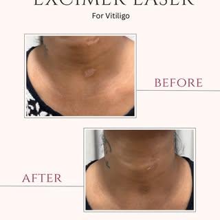 Targeted light. Visible change. ✨
Before & after Excimer Laser therapy, a focused treatment designed