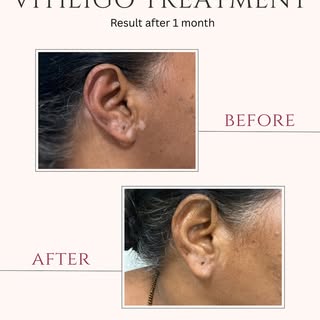 Vitiligo is not contagious, harmful, or something to be ashamed of 🤍
With the right diagnosis and t