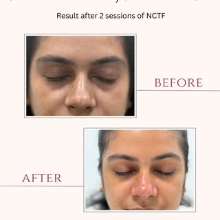 The eyes are often the first area to show signs of ageing. NCTF is a skin-rejuvenating treatment pac