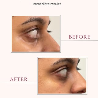 Tired eyes, refreshed look ✨
Under-eye filler can help restore lost volume, soften hollows, and redu