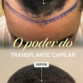Transplante lindo e hairline natural!
Estou apaixonada 😍 
Desde o desenho escolhido ao posicionamen