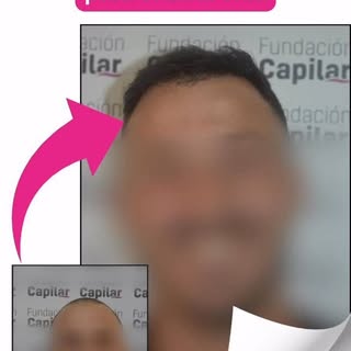 Casos reales y con solvencia médica.
¿Estás listo para tu implante capilar en Buenos Aires? #fundaci