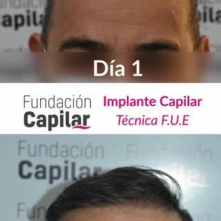 Implante capilar en Buenos Aires! 20 años de trayectoria