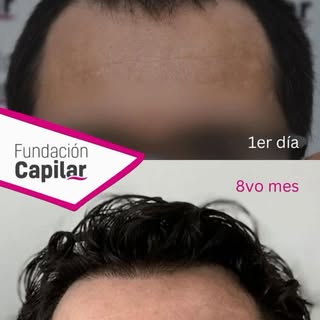 Somos el mejor centro de implante capilar en Buenos Aires, podes verificar más de 350 reseñas en Goo