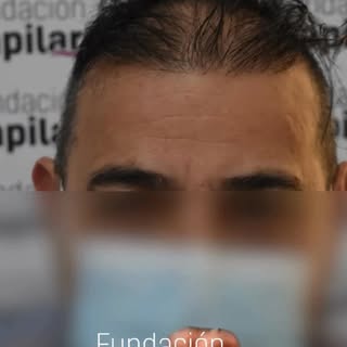 Cientos de casos y 2 décadas de experiencia en implantes capilares en Buenos Aires nos avalan. Consu