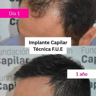 Cientos de casos de éxito en Implante Capilar en Buenos Aires avalan nuestra trayectoria. Consultamo