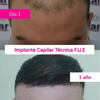 Pioneros en Implante en Buenos Aires 

Técnica FUE 

Consúltanos ahora