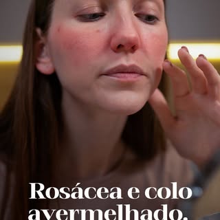 Vermelhidão constante não precisa ser ignorada como algo “normal”. A rosácea e o colo avermelhado po