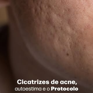 As cicatrizes de acne representam uma lembrança constante de uma fase que já passou, mas que ainda i