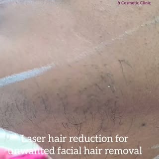 Say goodbye to unwanted hair and hello to smooth, confident skin!

Laser Hair Reduction is a safe, e
