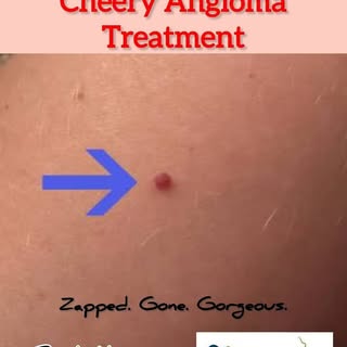 Cherry angioma Treatment