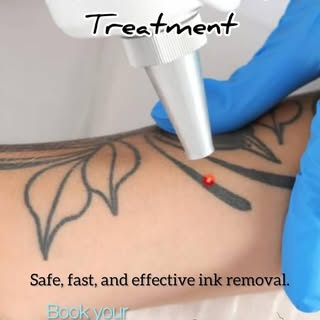 Tattoo Removal Treatment