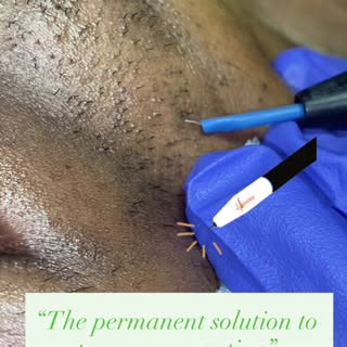 #drsoniamangal #myraskinhairsolutions #electrolysis #unwantedhairsolution #clearskin
