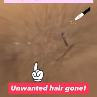 #drsoniamangal #myraskinhairsolutions #electrolysis #unwantedhairremoval #dermatologist