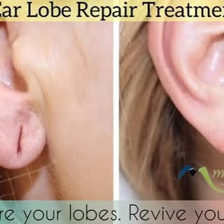Ear Lobe Repair Treatment