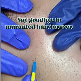 #drsoniamangal #myraskinhairsolutions #electrolysishairremoval #electrolysistreatment #unwantedhairr