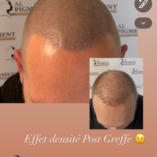 ✨ Effet densité post greffe ✨

Après sa greffe capillaire, notre client n’était pas totalement satis