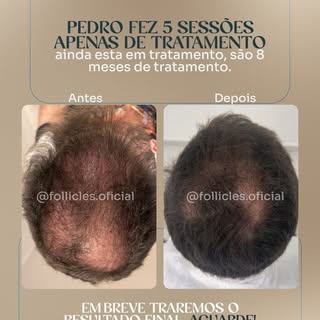 Início do tratamento: 22/12
Data da foto: 04/02

Em pouco mais de 40 dias e apenas 5 sessões, Pedro 