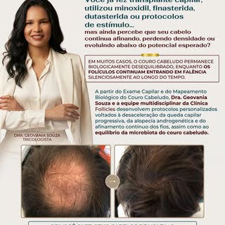 Você pode já ter realizado transplante capilar, utilizado minoxidil, finasterida, dutasterida ou div