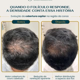 Quando o folículo responde, a densidade conta essa história.

A comparação mostra uma evolução real 