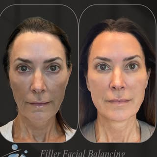 ✨Facial balancing focuses on harmony, not change. Botox softens fine lines, cheek filler restores yo