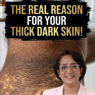 * Skin getting darker with age
* Maturational hyperpigmentation
* Acanthosis nigricans
* Insulin res