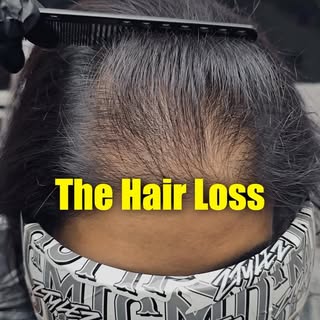 Postpartum hair loss is real and for some women, the density doesn’t fully return.

Women’s SMP crea